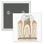 Illustration of Dental Filling Button