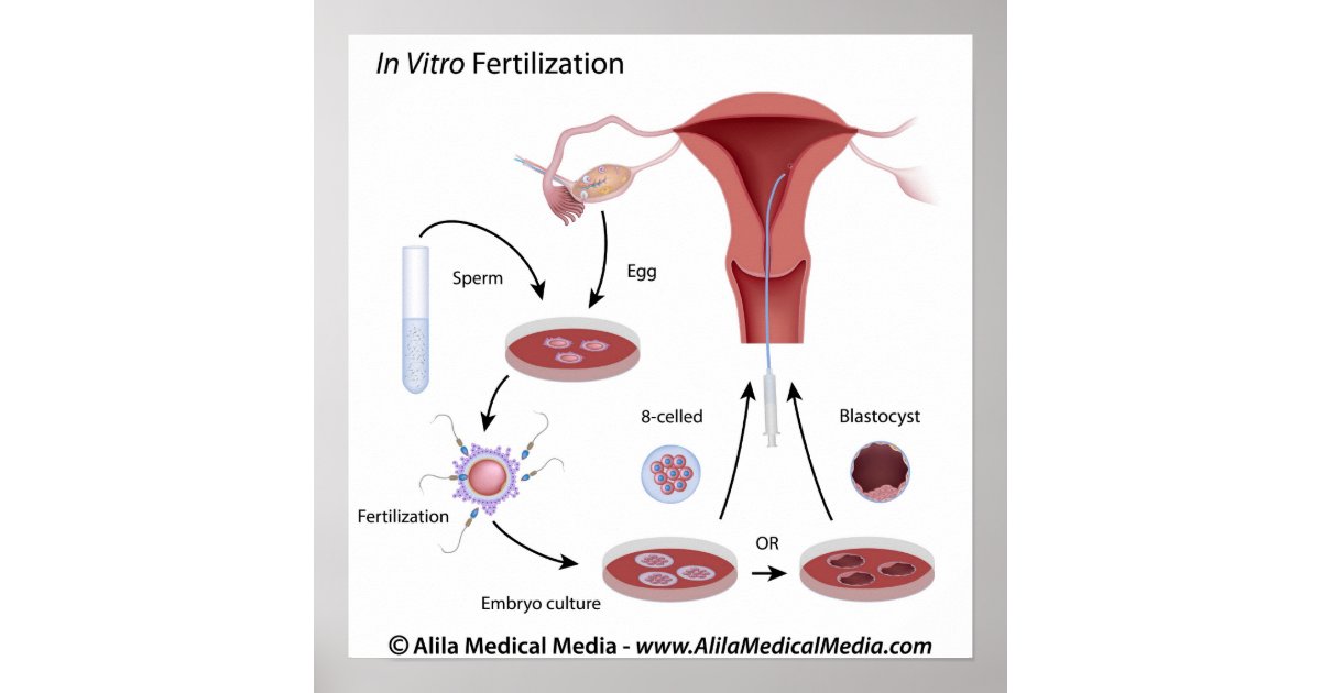 In Vitro Fertilization Ivf Procedure Labeled Poster Zazzle 8060
