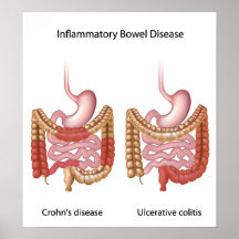 inflammatory bowel disease (ibd) poster