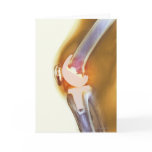 Knee replacement. Coloured X-ray of a total knee Cards