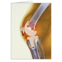 Knee replacement. Coloured X-ray of a total knee Cards