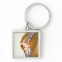 Knee replacement. Coloured X-ray of a total knee Key Chains
