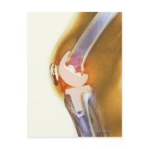 Knee replacement. Coloured X-ray of a total knee Postcards