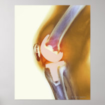 Knee replacement. Coloured X-ray of a total knee Print