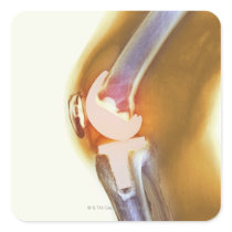 Knee replacement. Coloured X-ray of a total knee Square Sticker
