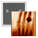 La primera X-Ray, 1901, fotografía botones