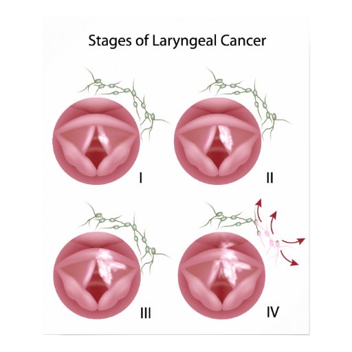 Laryngeal cancer stages Poster Zazzle