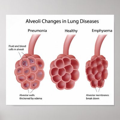 lung diseases Poster by Funzoo