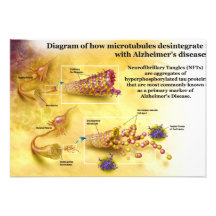 Microtubules Desintegration in Alzheimer's Disease Custom Announcements