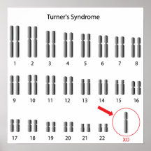 Monosomy X, Turner's syndrome Poster