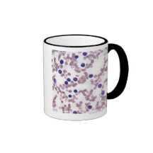 Neoplastic Lymphocyte Cells Coffee Mug