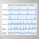 Normal and pathological ecg any size Poster posters