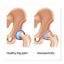 Osteoarthritis of hip joint  Poster