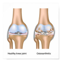 Osteoarthritis of knee joint Poster