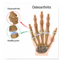 Osteoarthritis of the hand Poster