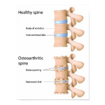 Osteoarthritis of the spine Poster