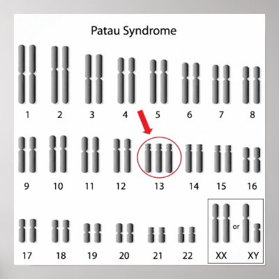 Patau Syndrome Pictures