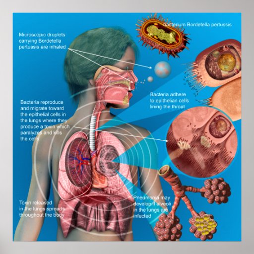 Pertussis (Whooping Cough) Poster | Zazzle