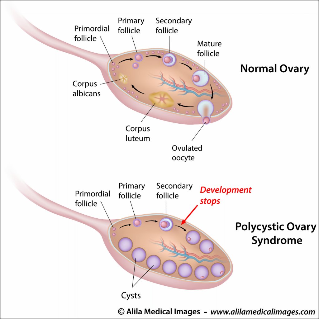 an overview of polycystic ovary syndrome essay an overview of polycystic ovary syndrome essay