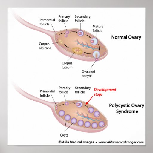 Polycystic Ovary Syndrome  Labeled Diagram  Poster