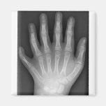 ¡Polydactyly, seis manos digitadas, radiografía, r imanes