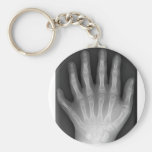 ¡Polydactyly, seis manos digitadas, radiografía, r llaveros
