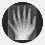¡Polydactyly, seis manos digitadas, radiografía, r calcomanías