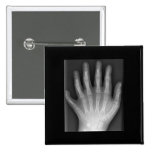 ¡Polydactyly, seis manos digitadas, radiografía, r botones