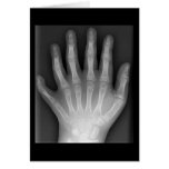 ¡Polydactyly, seis manos digitadas, radiografía, r tarjetas