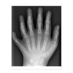 ¡Polydactyly, seis manos digitadas, radiografía, r tarjetas postales