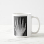 ¡Polydactyly, seis manos digitadas, radiografía, r tazas