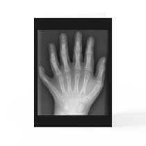 Polydactyly, Six Fingered Hand, X-Ray, rarity! cards