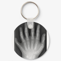 Polydactyly, Six Fingered Hand, X-Ray, rarity! keychains by harlowandcompany Polydactyly, Six Fingered Hand, X-Ray, rarity! keychains