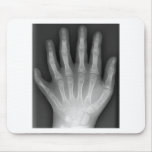 Polydactyly, Six Fingered Hand, X-Ray, rarity! Mouse Pad