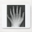 Polydactyly, Six Fingered Hand, X-Ray, rarity! mousepads by harlowandcompany Polydactyly, Six Fingered Hand, X-Ray, rarity! mousepads