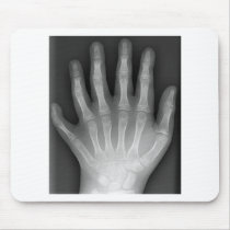 Polydactyly, Six Fingered Hand, X-Ray, rarity! mousepads