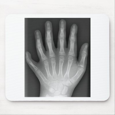 Polydactyly, Six Fingered Hand, X-Ray, rarity! Mouse Pad by harlowandcompany