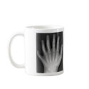 Polydactyly, Six Fingered Hand, X-Ray, rarity! mugs by harlowandcompany Polydactyly, Six Fingered Hand, X-Ray, rarity! mugs