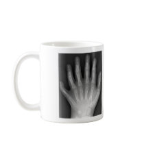Polydactyly, Six Fingered Hand, X-Ray, rarity! mugs by harlowandcompany Polydactyly, Six Fingered Hand, X-Ray, rarity! mugs