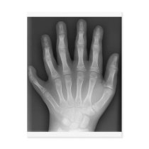 Polydactyly, Six Fingered Hand, X-Ray, rarity! postcards