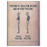 Position Of Skeleton In Good And In Poor Posture Flyer Design