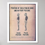 Position Of Skeleton In Good And In Poor Posture Poster