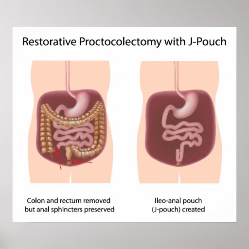 Restorative proctocolectomy surgery with jpouch poster