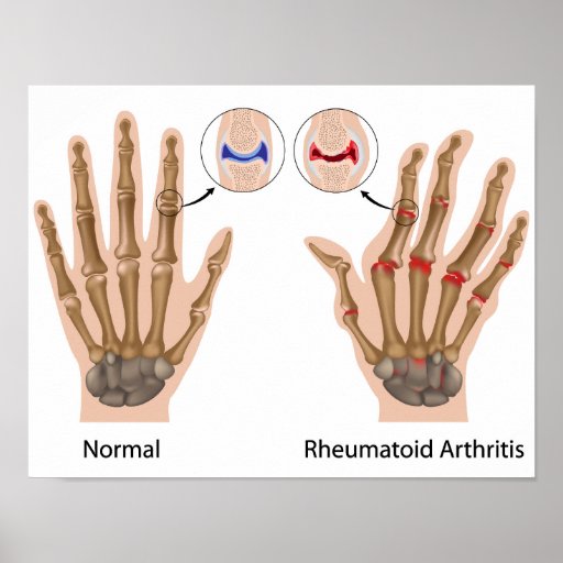 Rheumatoid arthritis of finger joint Poster Zazzle