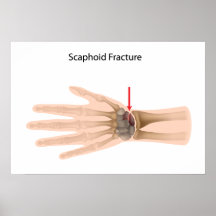 Scaphoid wrist fracture Poster