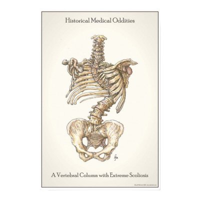 Scoliosis Spine Print by docmitchell