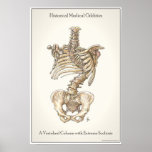 Scoliosis Spine Print
