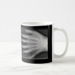 Seis manos digitadas, rareza médica, radiografía tazas