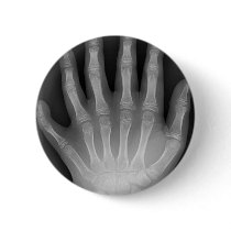 Six Fingered Hand, Medical Rarity, X-Ray buttons by harlowandcompany Six Fingered Hand, Medical Rarity, X-Ray buttons