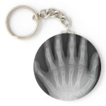 Six Fingered Hand, Medical Rarity, X-Ray Keychains